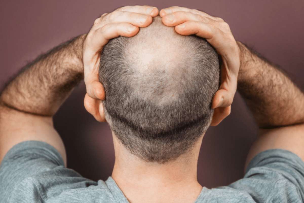 bald spot crown hair transplant