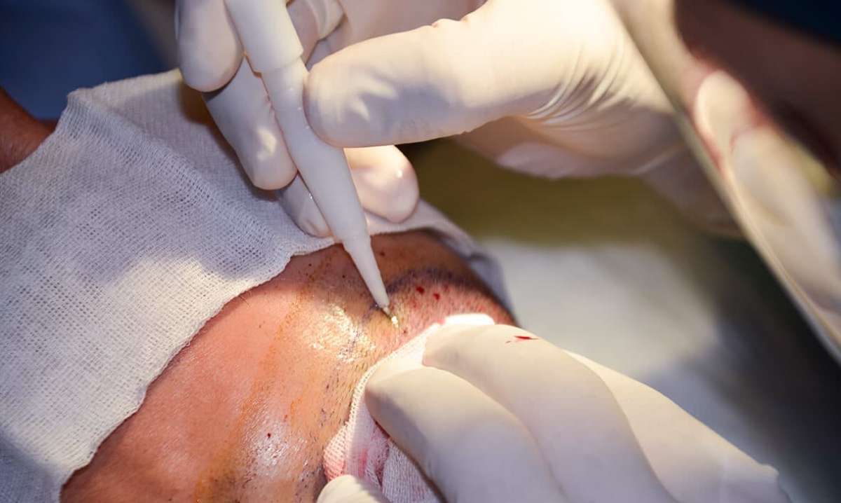 dhi fue hair transplant