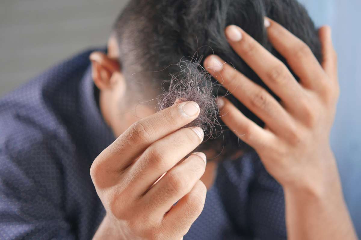 telogen effluvium hair shedding